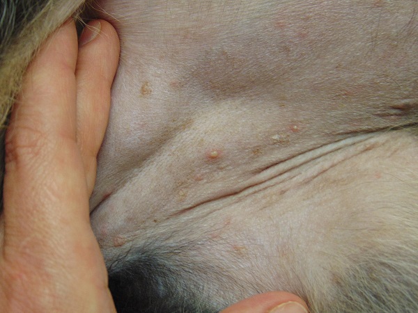Acne sa usa ka iring / iring sa tiyan