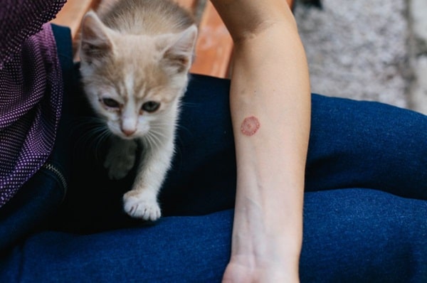 Стригучий лишай у людини