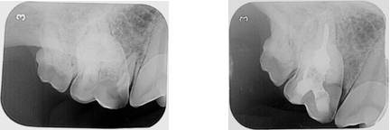 Дентальна рентгенографія першого моляра справа на верхній щелепі