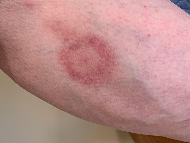 Як відчувається укус павука та кліща