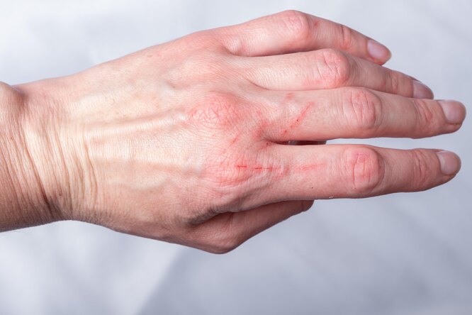 Хвороба котячих подряпин