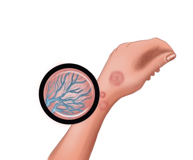 Так виглядає дерматофітоз у людини