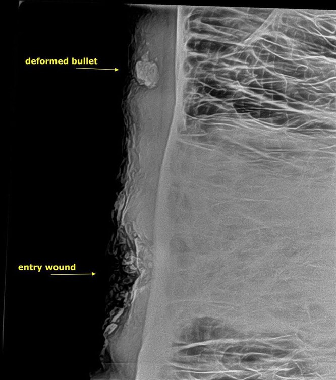 Рентген показав, що куля застрягла у кістці